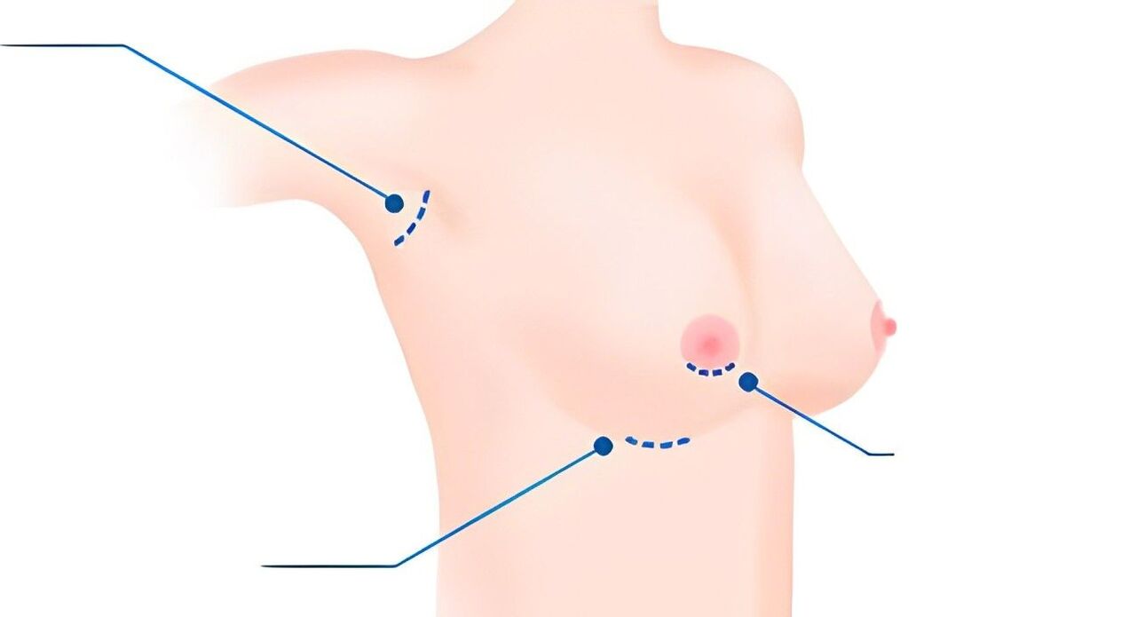 types de tailles pour l'augmentation mammaire